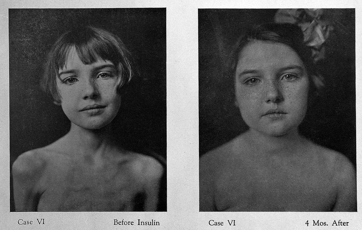 Antes y después de recibir el tratamiento de insulina