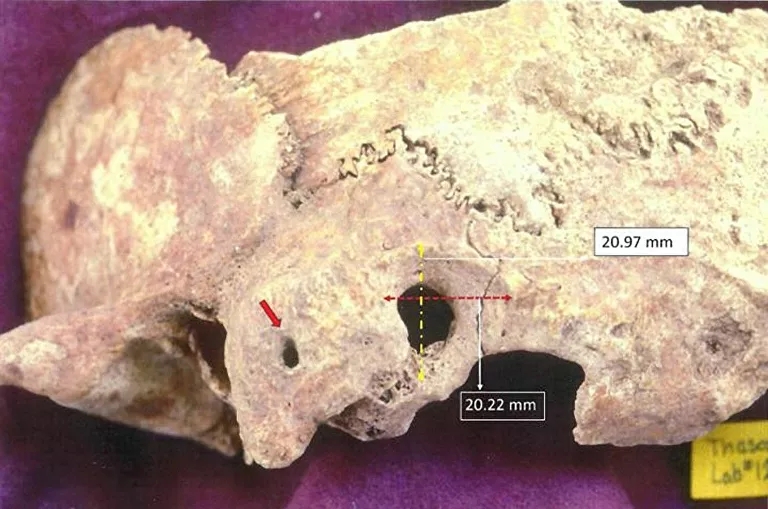 Vista ecocránea de la muestra paleopatológica: a) la flecha roja apunta al orificio de la apófisis mastoides, y b) las dimensiones de la preparación quirúrgica son periféricas a la trepanación