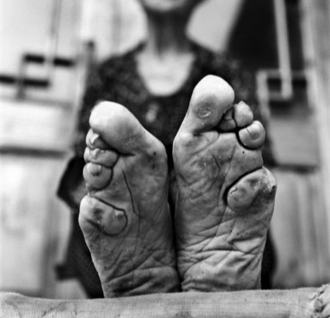 Pies de una mujer china a la que se ataron los pies