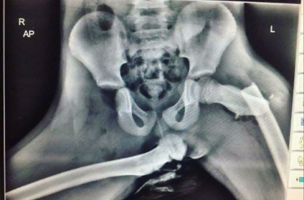Radiografía de accidentado con pies en salpicadero