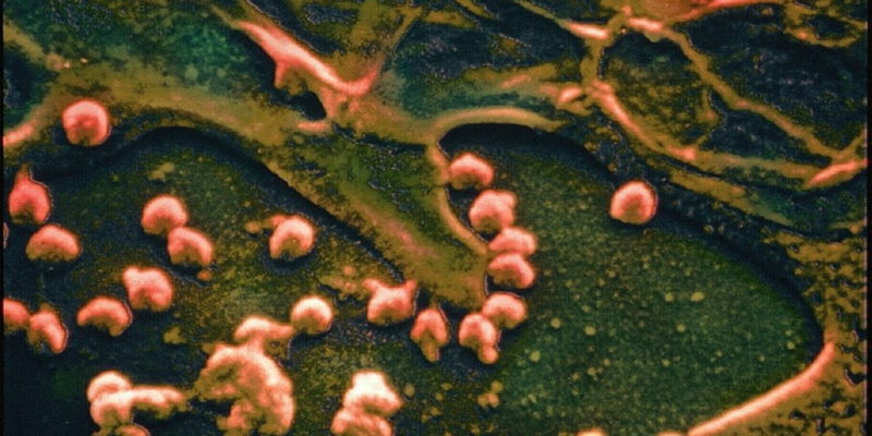 Células hepáticas infectadas por el virus del sida